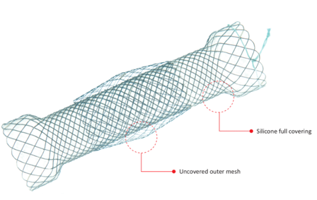 Niti-S™ Esophageal Double Anti Reflux Stent