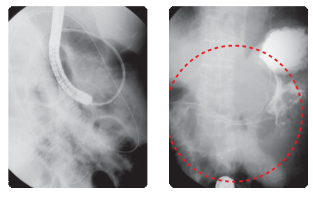Niti-S Pyloric/duodenal S-Type™ Over The Wire
